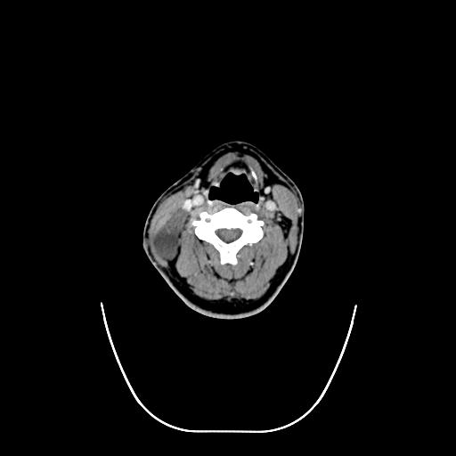 Branchial cleft cyst (Radiopaedia 31167-31875 Coronal C+ delayed 1).jpg