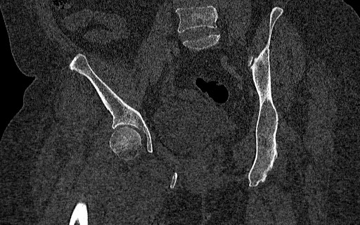 Breast carcinoma with pathological hip fracture (Radiopaedia 60314-67993 Coronal bone window 71).jpg