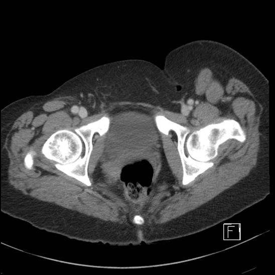 File:Breast metastases from renal cell cancer (Radiopaedia 79220-92225 C 118).jpg