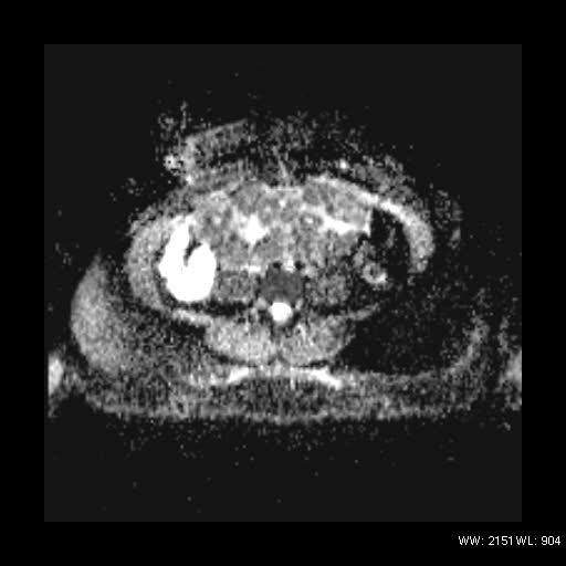 File:Broad ligament fibroid (Radiopaedia 49135-54241 Axial ADC 4).jpg
