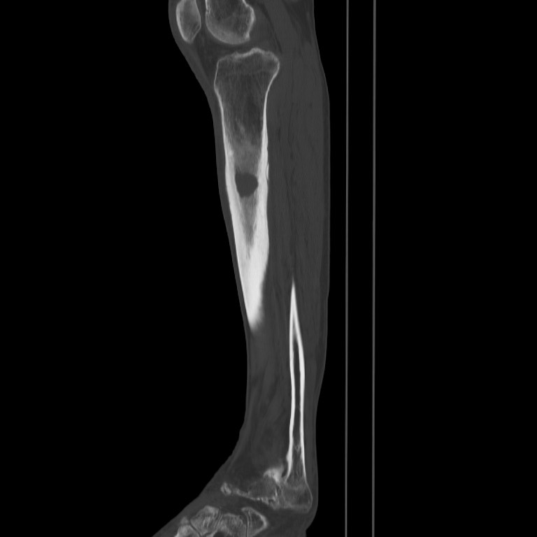 Brodie abscess - tibia (Radiopaedia 66028-75204 Sagittal bone window 44).jpg