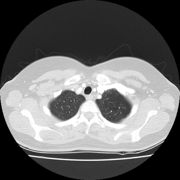 Bronchial atresia (Radiopaedia 22965-22992 Axial lung window 45).jpg