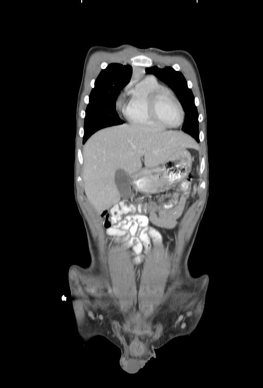 Bronchial carcinoid tumor (Radiopaedia 57187-64090 B 7).jpg