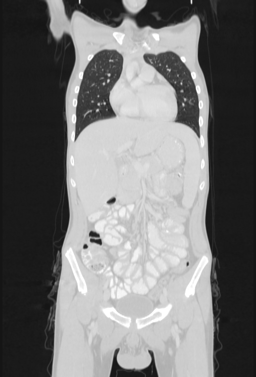 Bronchial carcinoid tumor (Radiopaedia 57187-64090 Coronal lung window 29).jpg