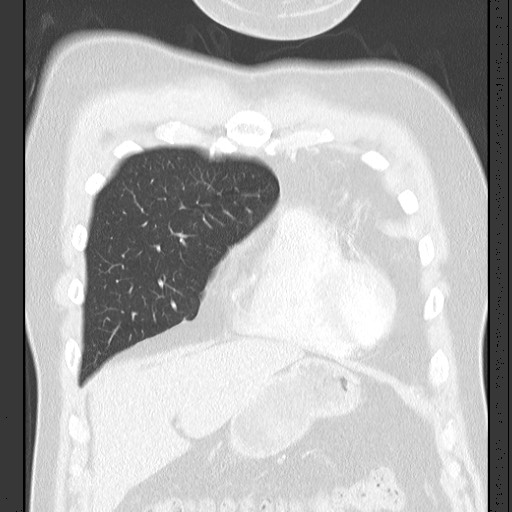 Bronchial carcinoid tumor (Radiopaedia 67377-76764 Coronal lung window 22).jpg