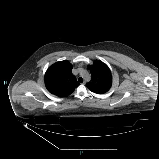 Bronchial carcinoid tumor (Radiopaedia 78272-90870 Axial non-contrast 25).jpg