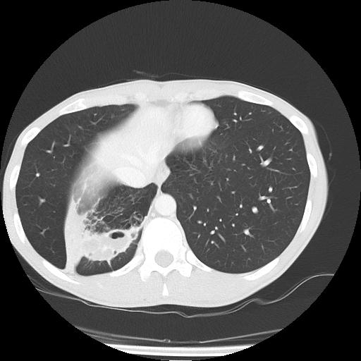 Bronchial carcinoid tumor causing right lower lobe collapse (Radiopaedia 83495-98594 Axial lung window 43).jpg