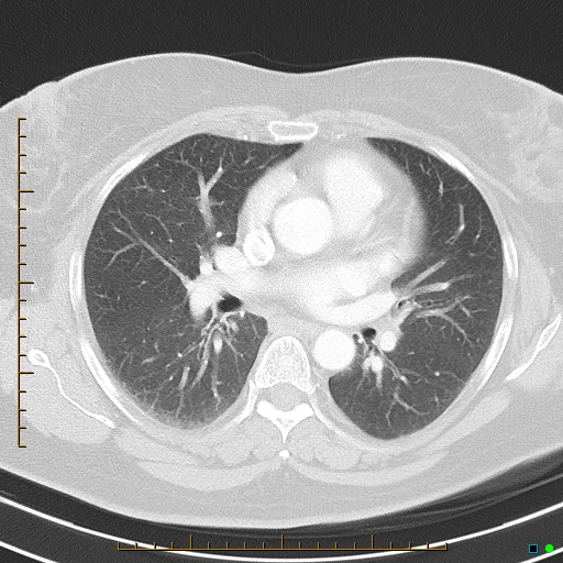 File:Bronchial diverticula (Radiopaedia 79512-92675 Axial lung window 24).jpg
