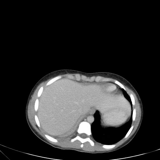 Bronchial mucoepidermoid carcinoma (Radiopaedia 57023-63895 Axial 84).jpg