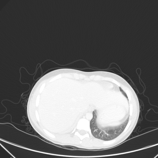 Bronchial mucoepidermoid carcinoma (Radiopaedia 57023-63895 Axial lung window 99).jpg