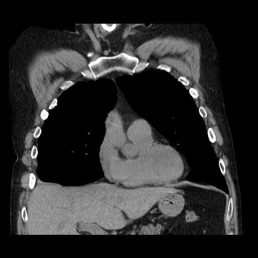 File:Bronchial stenosis - lung transplant (Radiopaedia 73133-83848 Coronal non-contrast 25).jpg