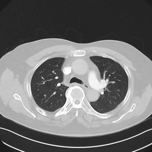 Bronchiectasis (Radiopaedia 39385-41666 Axial lung window 24).png