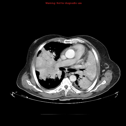 File:Bronchioloalveolar carcinoma (Radiopaedia 9272-9955 A 14).jpg