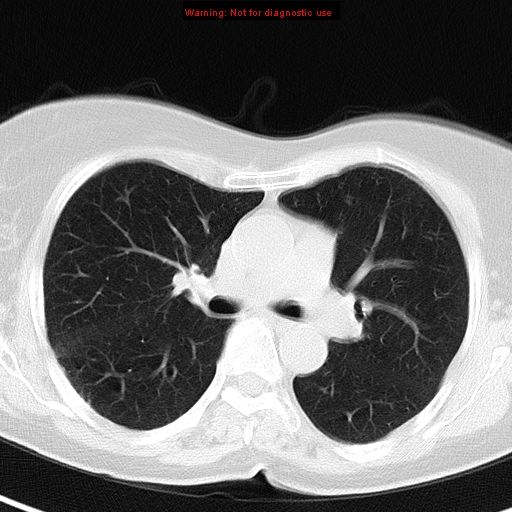 File:Bronchoalveolar carcinoma (BAC) (Radiopaedia 13436-13392 Axial lung window 22).jpg