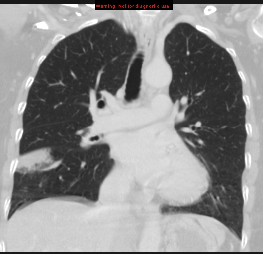 Bronchoalveolar carcinoma (BAC) (Radiopaedia 13436-13392 Coronal lung window 29).jpg