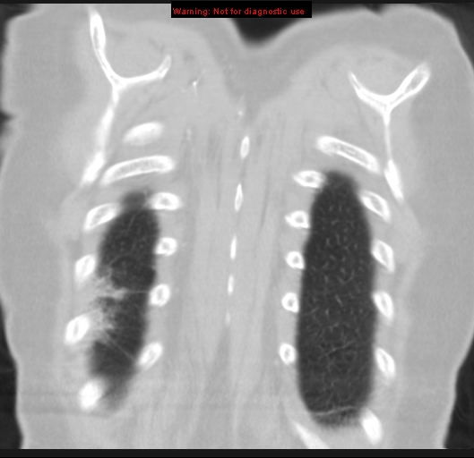Bronchoalveolar carcinoma (BAC) (Radiopaedia 13436-13392 Coronal lung window 55).jpg