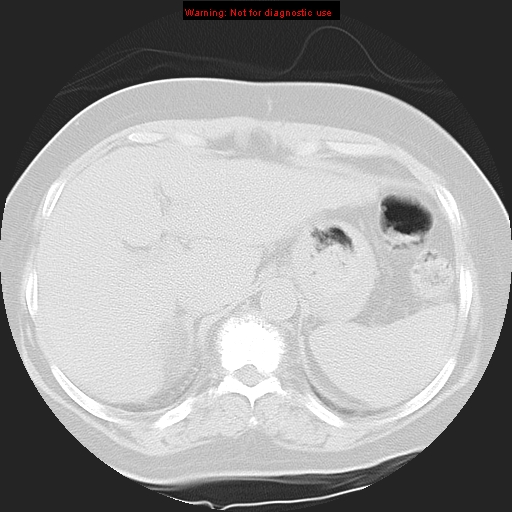 File:Bronchoalveolar carcinoma (Radiopaedia 13224-13233 Axial lung window 42).jpg