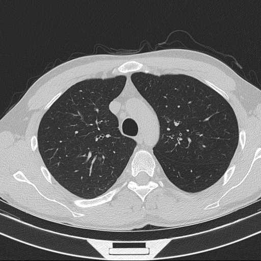 File:Bronchocele (Radiopaedia 60676-68429 Axial lung window 20).jpg