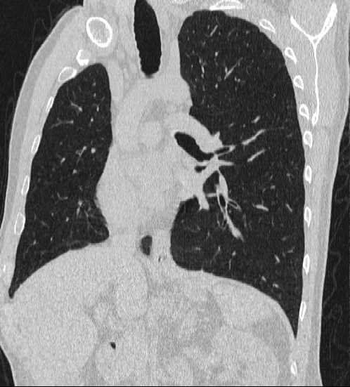 File:Bronchocele (Radiopaedia 60676-68429 Oblique lung window 14).jpg