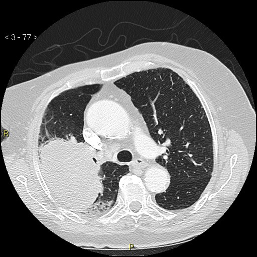 Bronchogenic carcinoma as an incidental finding (Radiopaedia 16453-16130 Axial lung window 77).jpg
