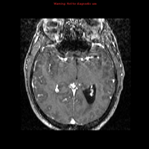 File:Bronchogenic carcinoma brain metastasis (Radiopaedia 9286-9969 Axial T1 C+ 1).jpg