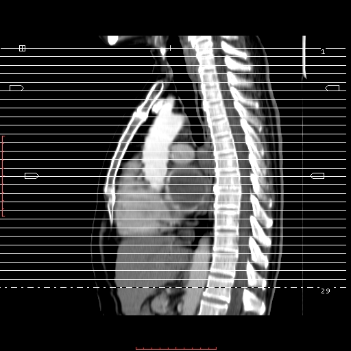 File:Bronchogenic carcinoma with left atrial large deposit - T4N3M1a (Radiopaedia 42316-45428 A 1).jpg