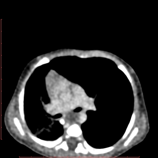 Bronchogenic cyst (Radiopaedia 78599-91409 B 95).jpg