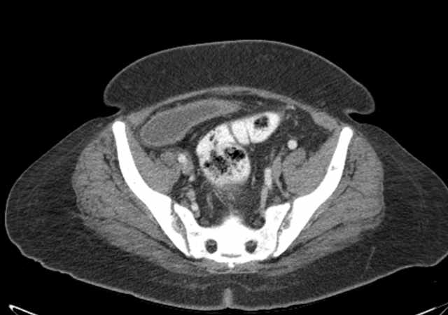 File:Brown tumors compressing the spinal cord (Radiopaedia 68442-77988 E 100).jpg