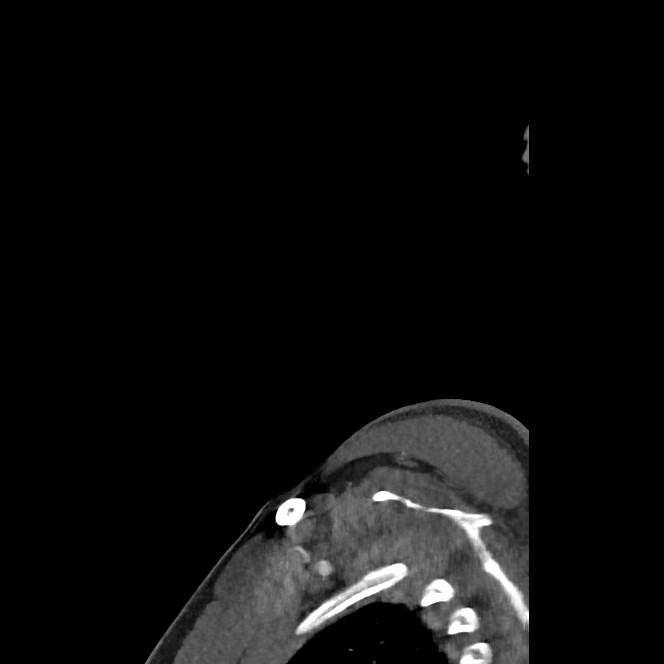Buccal fat pad arteriovenous malformation (Radiopaedia 70936-81144 C 14).jpg