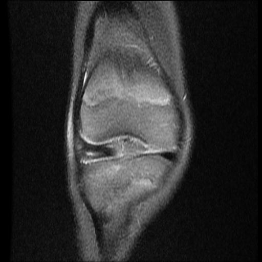 File:Bucket handle tear - lateral meniscus (Radiopaedia 72124-82634 Coronal PD fat sat 5).jpg