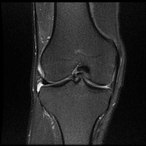 File:Bucket handle tear - medial meniscus (Radiopaedia 69245-79026 Coronal PD fat sat 11).jpg