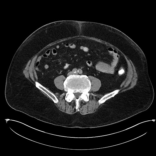 Buried bumper syndrome - gastrostomy tube (Radiopaedia 63843-72577 Axial Inject 76).jpg