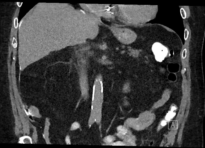 Buried bumper syndrome - gastrostomy tube (Radiopaedia 63843-72577 Coronal Inject 67).jpg