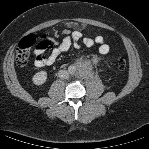 Burned-out testicular seminoma - retroperitoneal nodal metastases (Radiopaedia 62872-71245 A 42).jpg