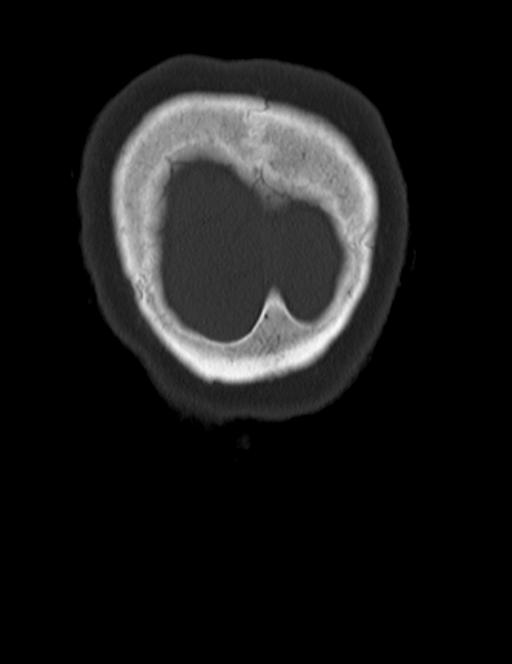 Burnt-out meningioma (Radiopaedia 51557-57337 Coronal bone window 54).jpg