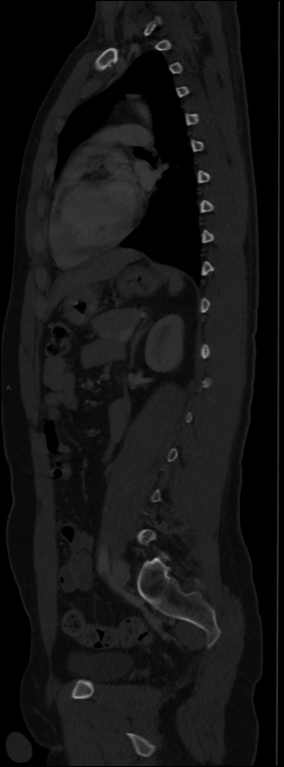 Burst fracture (Radiopaedia 83168-97542 Sagittal bone window 79).jpg