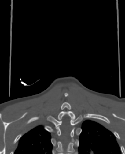 Butterfly vertebra (Radiopaedia 77903-90209 Coronal bone window 91).jpg