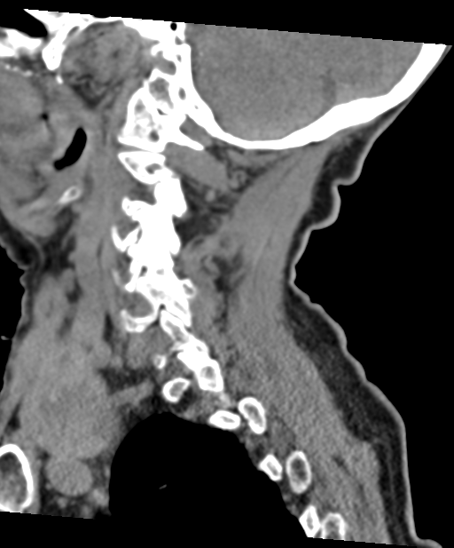 C2 fracture with vertebral artery dissection (Radiopaedia 37378-39199 D 54).png