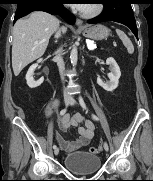 Calcified adrenal glands and Spigelian hernia (Radiopaedia 49741-54988 B 58).jpg