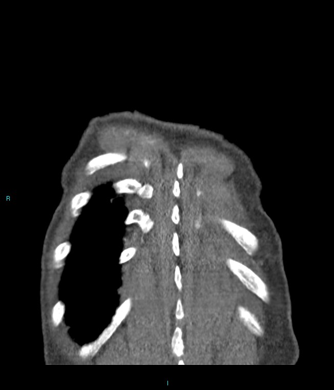 Calcified cerebral emboli from left ventricular thrombus (Radiopaedia 84420-99760 Coronal C+ CTPA 7).jpg