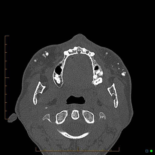 Calcified facial augmentation fillers (Radiopaedia 79514-92679 Axial bone window 78).jpg