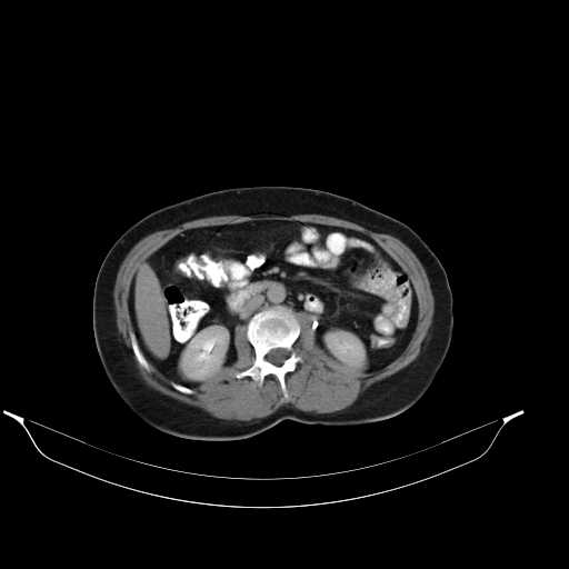 File:Calcified hydatid cyst of the liver (Radiopaedia 21212-21112 Axial C+ delayed 26).jpg