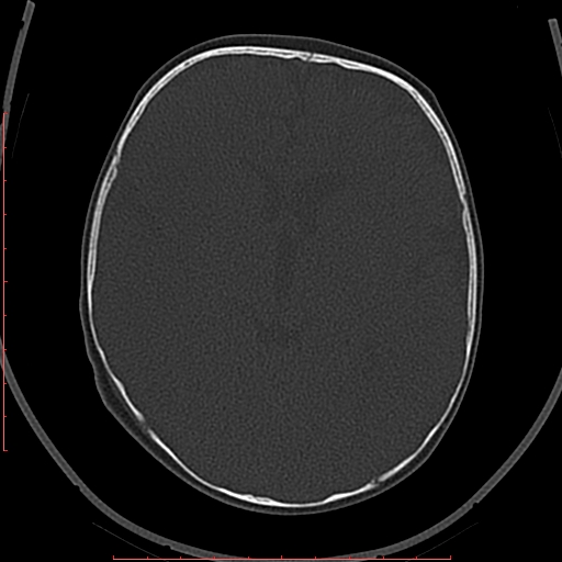 File:Calcified middle cerebral artery embolism (Radiopaedia 78949-91860 Axial bone window 29).jpg
