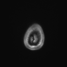 Callosal dysgenesis with interhemispheric cyst (Radiopaedia 53355-59335 Axial T1 157).jpg