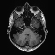 Callosal dysgenesis with interhemispheric cyst (Radiopaedia 53355-59335 Axial T1 36).jpg