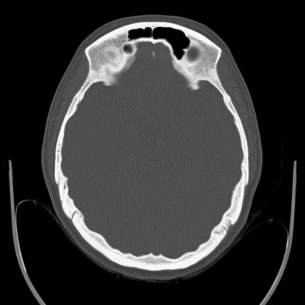 Calvarial osteoma (Radiopaedia 36520-38079 Axial bone window 41).jpg