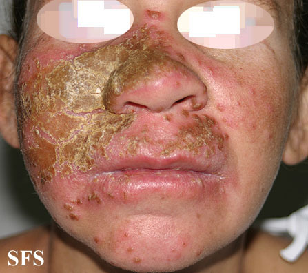 Candidiasis Chronic Mucocutaneos (Dermatology Atlas 9).jpg