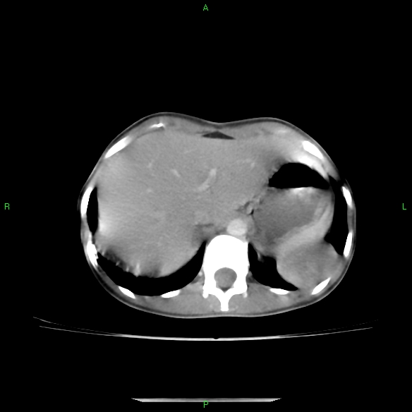 File:Cannon ball metastases - synovial sarcoma (Radiopaedia 26135-26271 C 34).jpg