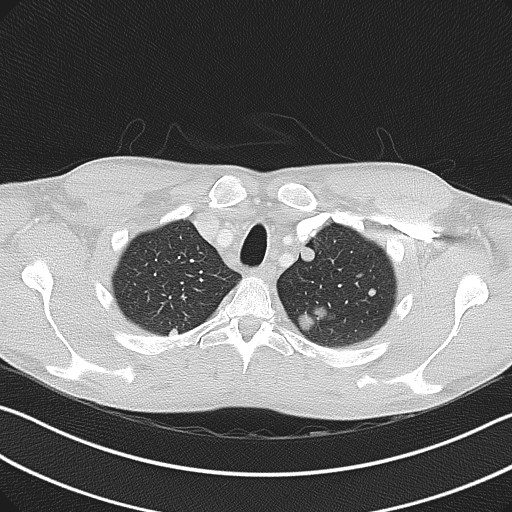 File:Cannonball metastases - testicular choriocarcinoma (Radiopaedia 84510-99891 Axial lung window 19).jpg
