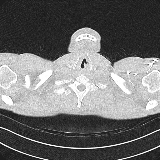Cannonball metastases - testicular choriocarcinoma (Radiopaedia 84510-99891 Axial lung window 4).jpg